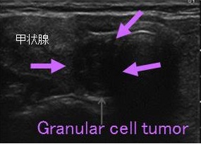 Granular cell tumor超音波検査(エコー)画像 Granular cell tumor超音波検査(エコー)画像